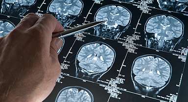 Alzheimer hastalığında yeni gelişme! Beyindeki damarları korumak mümkün olabilir